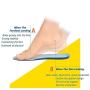 MQUPIN Plantar Fasciitis Gel Insoles for Women / Men, Arch Support & Pain Relief & Flat Feet Correction Shoe Pads for Sneakers, Heels, Work Boots, 6 - 10 Size (2 Pairs)