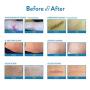 Aroamas Professional Silicone Scar Sheets, Soften and Flattens Scars Resulting from Surgery, Injury, Burns, Acne, C-section and more, Soft Silicone Scar Strips, 3&quot×1.57&quot, 8 Sheets (4 Month Supply)