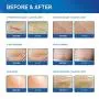 St. Mege Medical-Grade Drug-Free Silicone Scar Sheets for C-Section, Softens & Flattens Stretch Marks, Acne, Burn, Cosmetic Surgery, Keloid Scars (5.7"×1.57”, 4 pcs, 8 Week Supply)